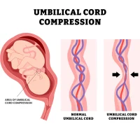 baby-umbilical-cord-compression
