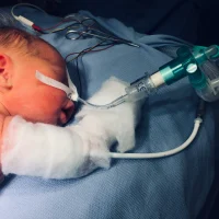 newborn-during-a-surgery